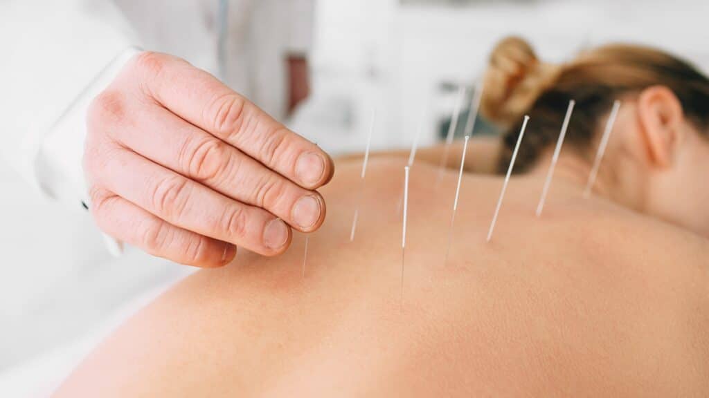 Woman lying on her stomach while an Acupuncturist places needles in her back.
